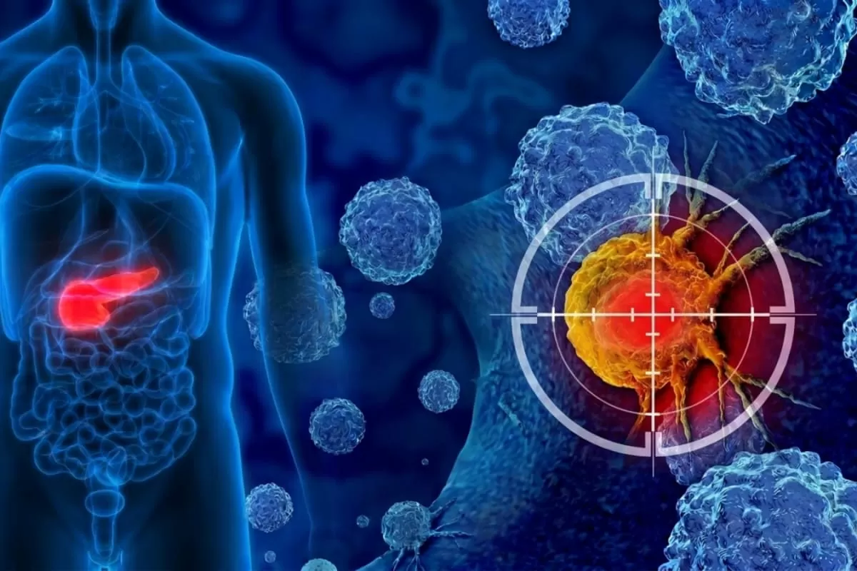 Unexplained Weight Loss, Jaundice, Or Back Pain? 8 Silent Pancreatic Cancer Signs You Should Never Ignore