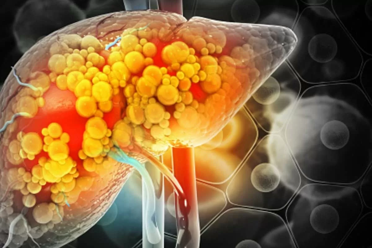 Can Fatty Liver Be Reversed? Doctors Share Tests And Key Lifestyle Tips